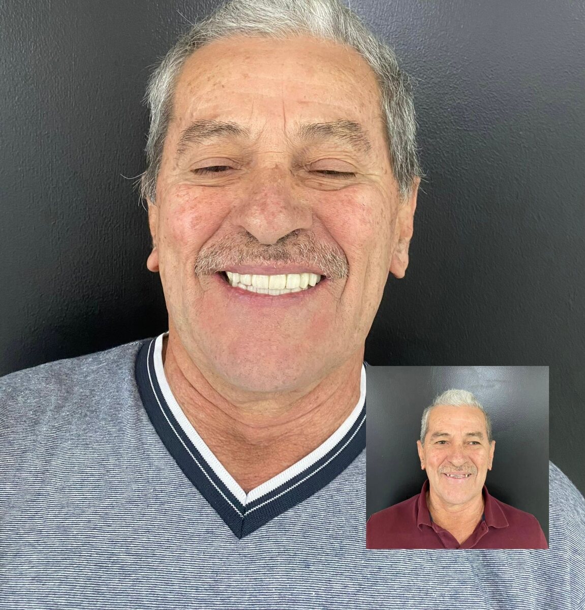 Before and after - fixed teeth on implants