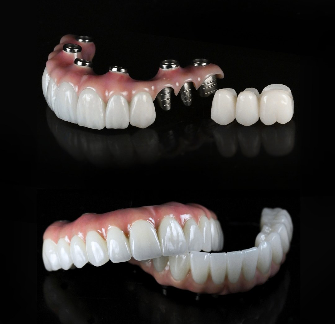 All-on-4 and All-on-6 full-arch prostheses on titanium implants