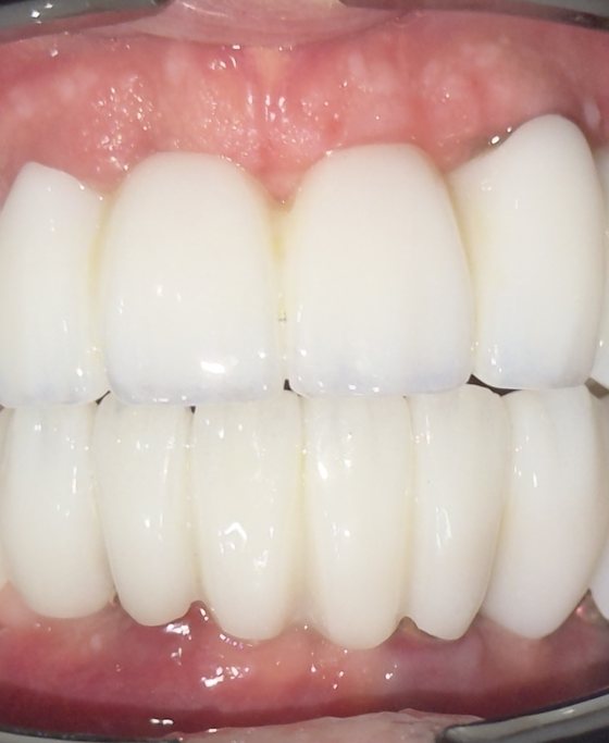 After full-arch implant treatment