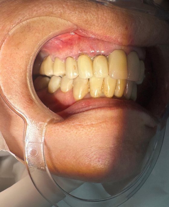 Before full-arch implant treatment