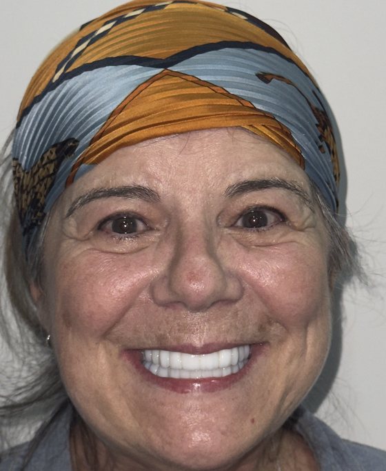 Patient of Dr. Erick Rivera after full-arch implant treatment