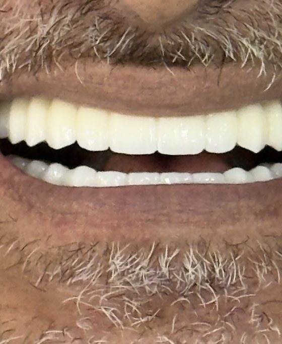 After full-arch implant treatment