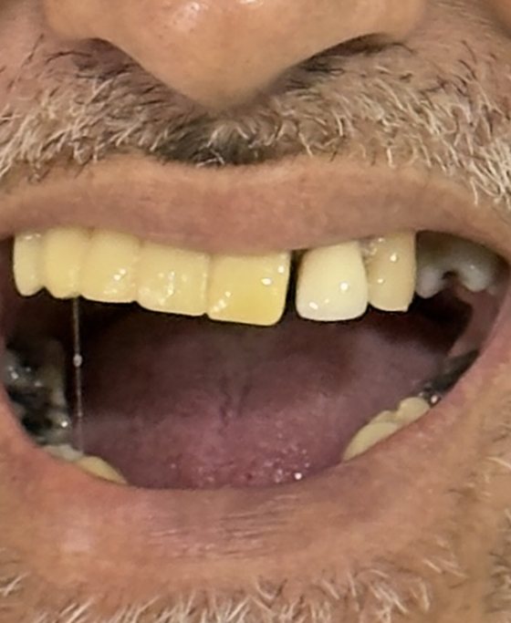 Before full-arch implant treatment