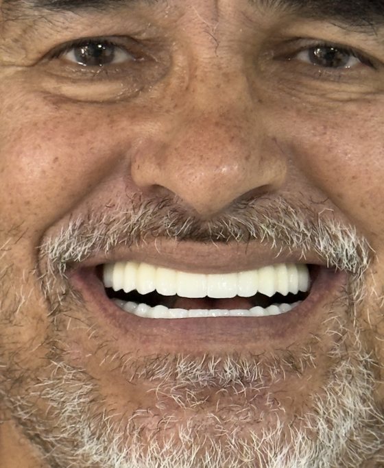 Patient of Dr. Erick Rivera after full-arch implant treatment