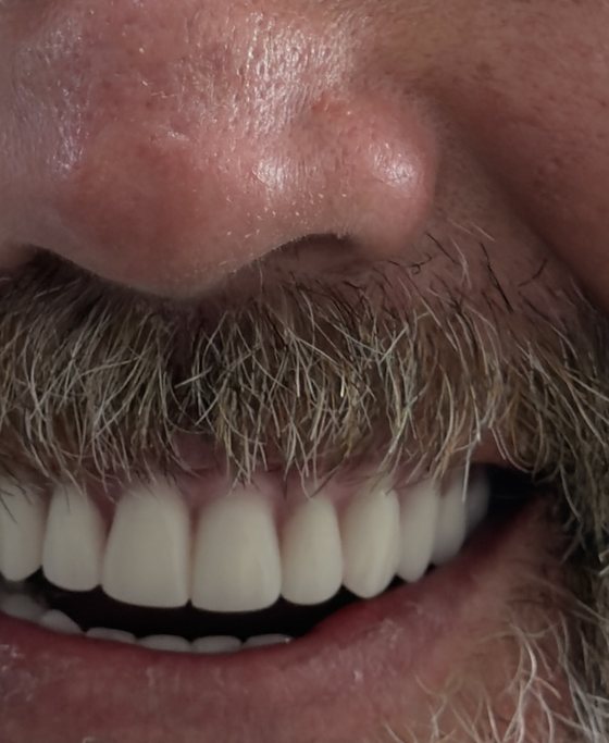After full-arch implant treatment