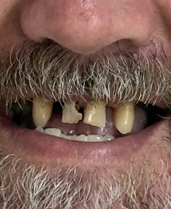 Before full-arch implant treatment