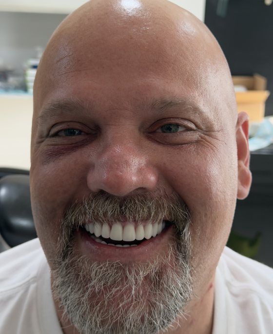Patient of Dr. Erick Rivera after full-arch implant treatment