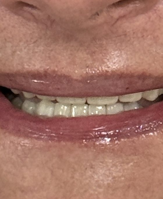 After full-arch implant treatment