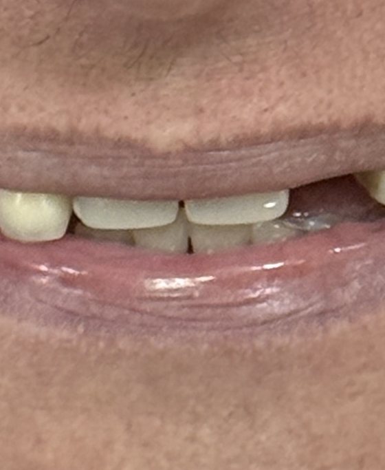 Before full-arch implant treatment