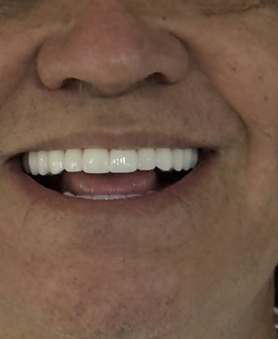 After full-arch implant treatment