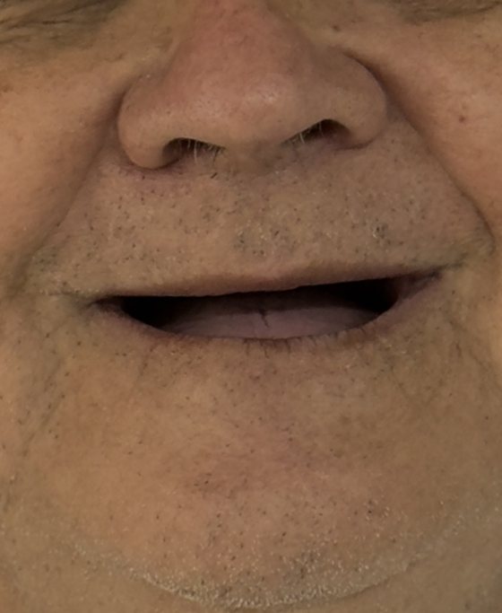Before full-arch implant treatment