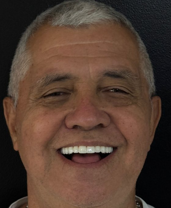 Patient of Dr. Erick Rivera after full-arch implant treatment