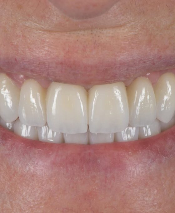 After full-arch implant treatment