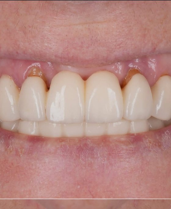Before full-arch implant treatment