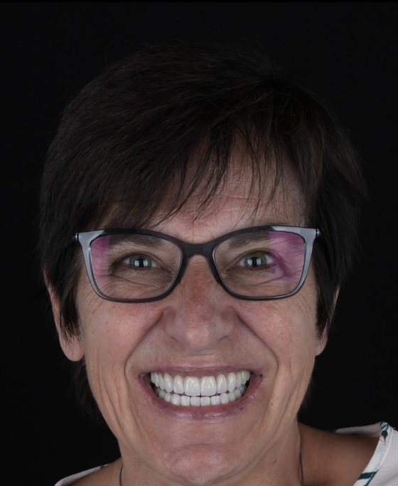 Patient of Dr. Erick Rivera after full-arch implant treatment