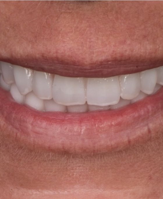 After full-arch implant treatment