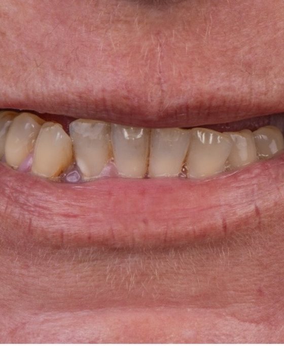 Before full-arch implant treatment