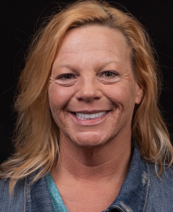 Patient of Dr. Erick Rivera after full-arch implant treatment