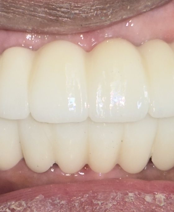 After full-arch implant treatment