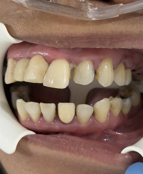 Before full-arch implant treatment