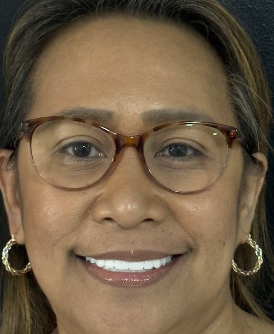 Patient of Dr. Erick Rivera after full-arch implant treatment